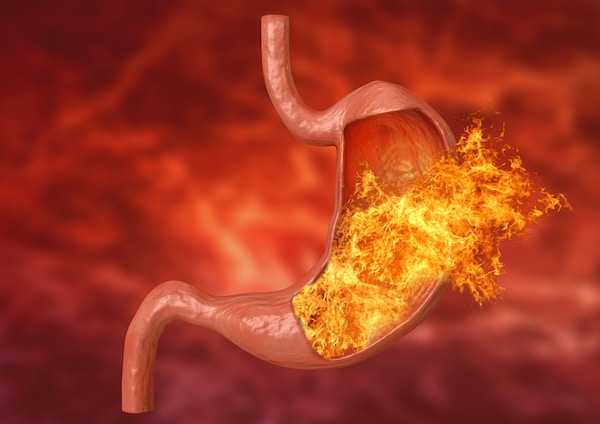 Gastritis The Emergency Center