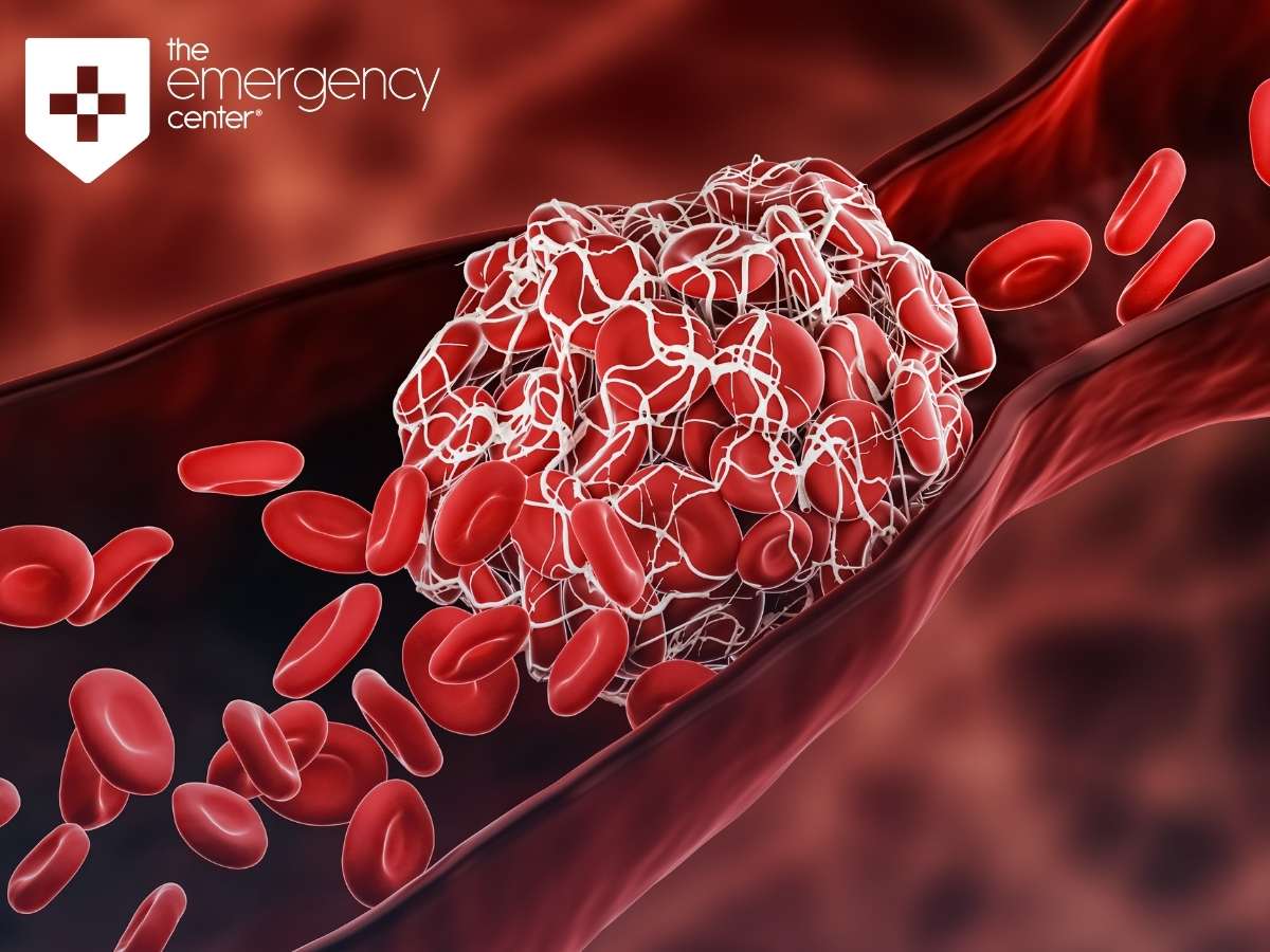 When Blood Clots Become An Emergency