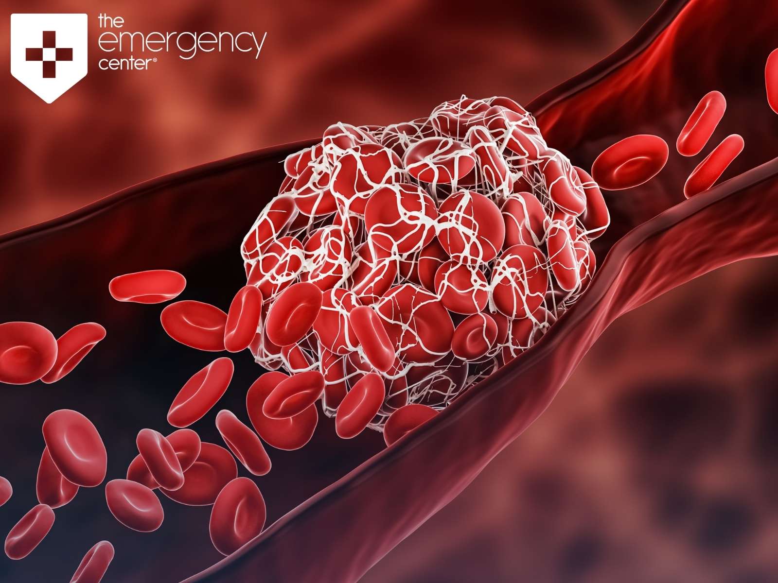 When a Blood Clot Becomes An Emergency