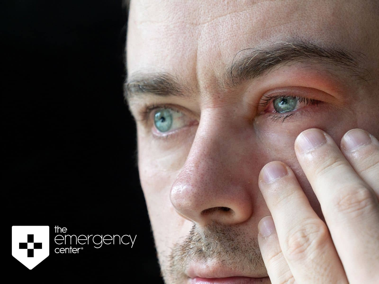 Pink eye: What it is and how to treat it