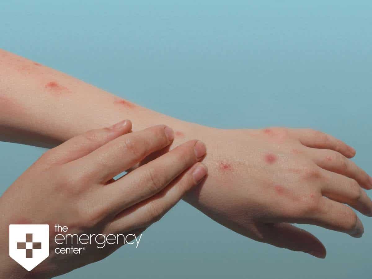 Here Are Three Signs You May Have Monkeypox