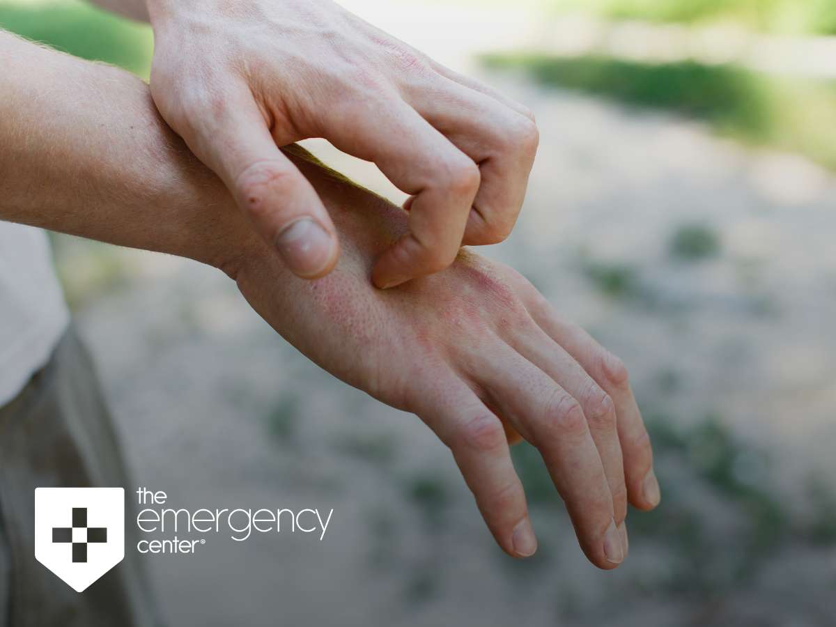 Close-up of a person's hand showing a visible rash on the skin