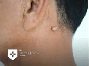 Close-up of a small, raised cyst on a person's neck just below the ear