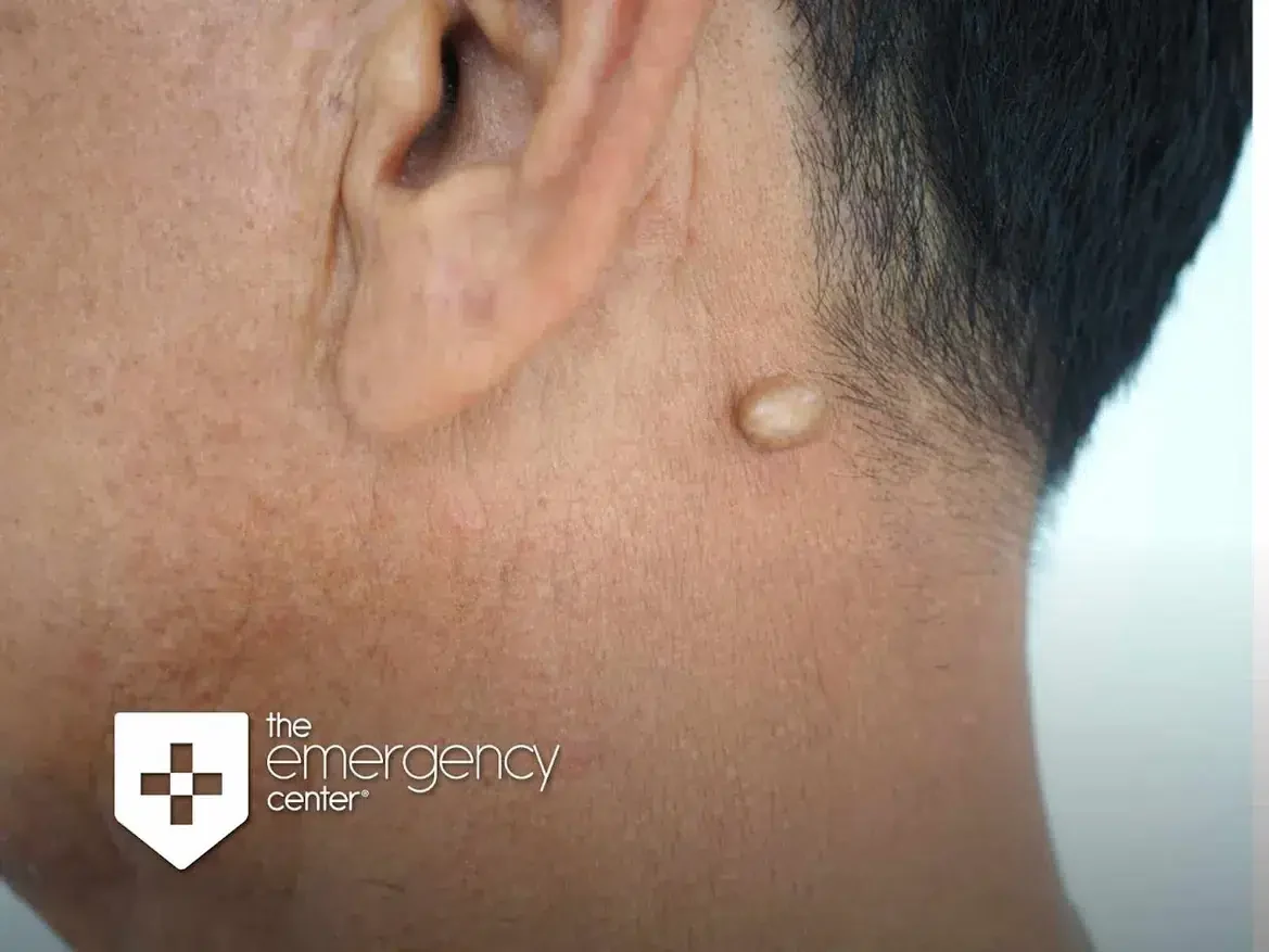 Close-up of a small, raised cyst on a person's neck just below the ear
