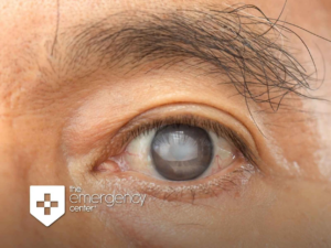 Close-up of an eye with a clouded grey cornea